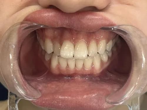 Smile transformation 3 - Before