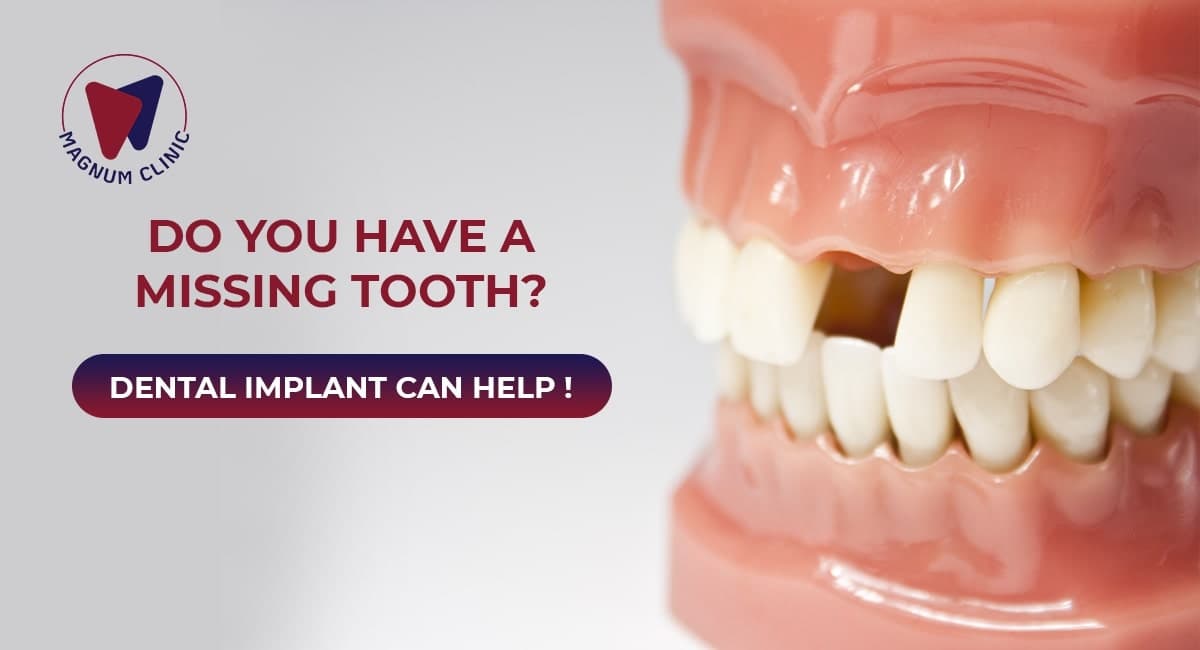 Do You Have a Missing Tooth? Dental Implant Can Help!