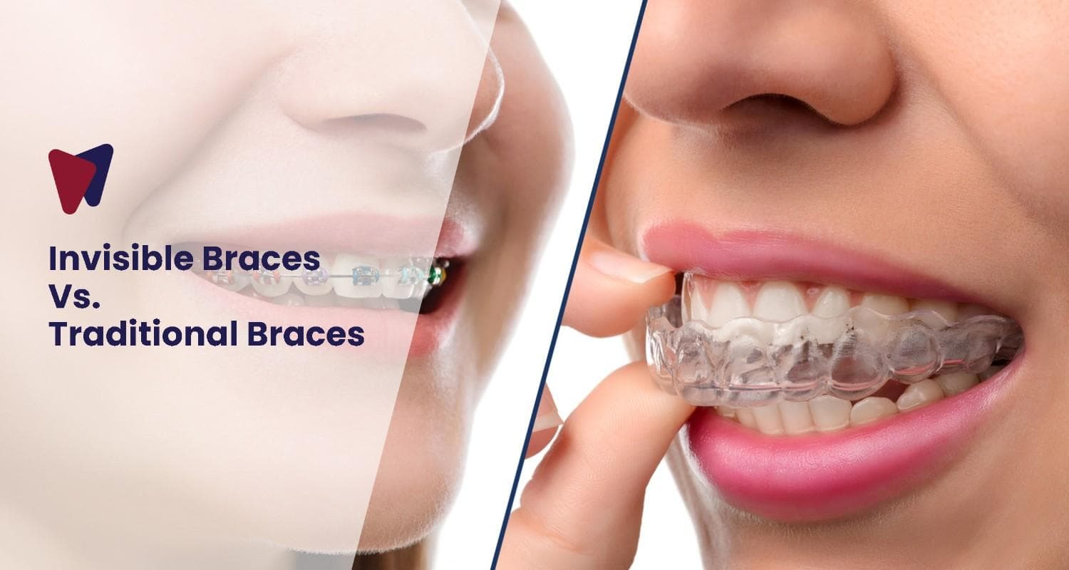 Invisible Braces Vs. Traditional Braces: Which Is The Best Choice?