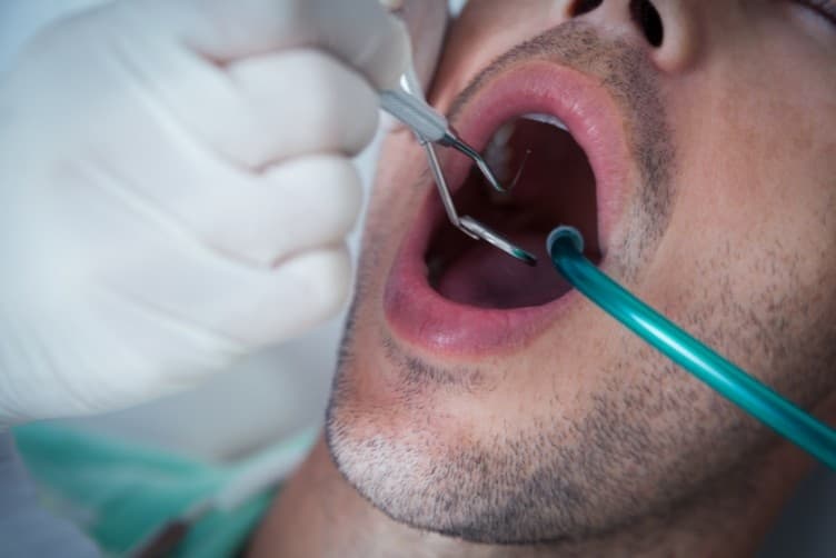 When Do You Need Teeth Extraction? A Dubai Dentist Explains