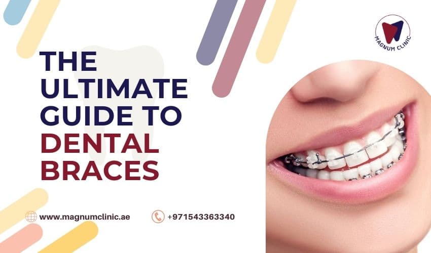 The Ultimate Guide to Dental Braces - A Comprehensive Overview