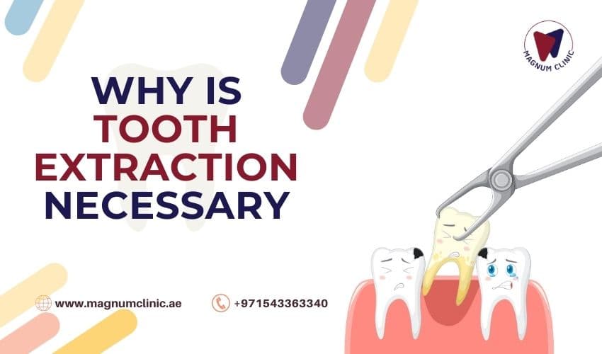 Why Is Tooth Extraction Necessary, and When Is It Recommended?