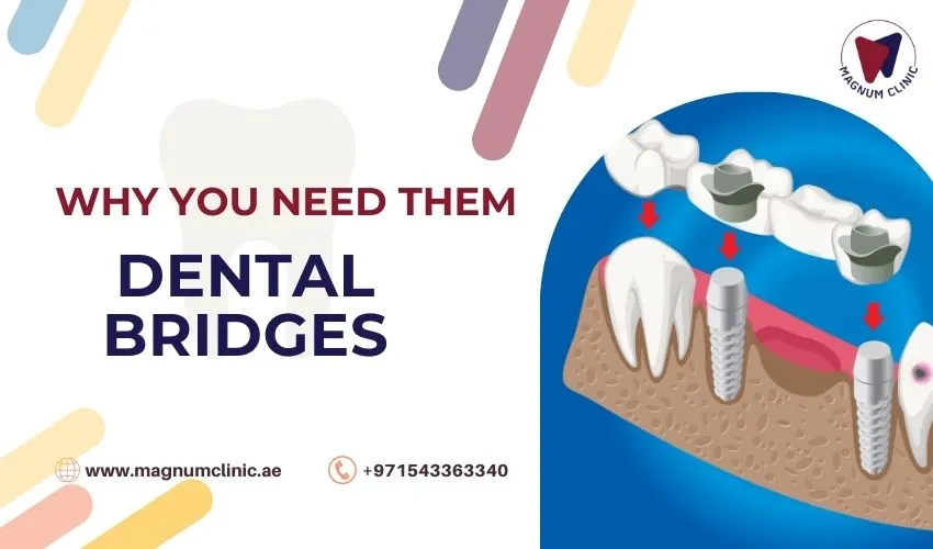 Dental Bridges: Why You Need Them, Types, Procedure And Advantages
