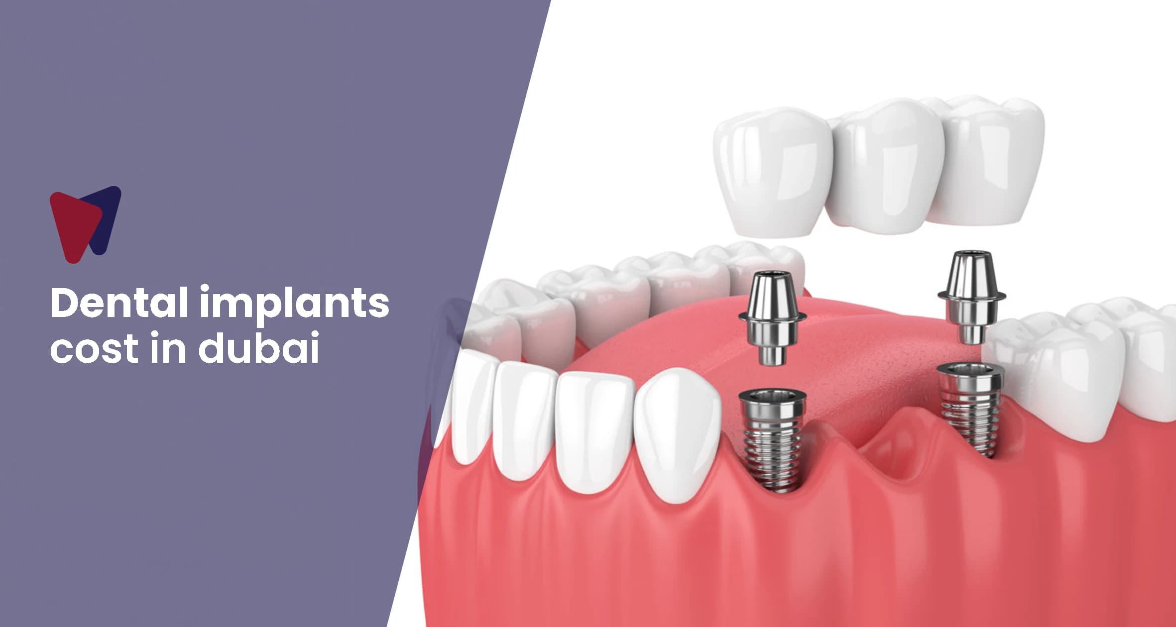 The Ultimate Guide to Dental Implant Costs and Procedures in Dubai (2025 Edition)