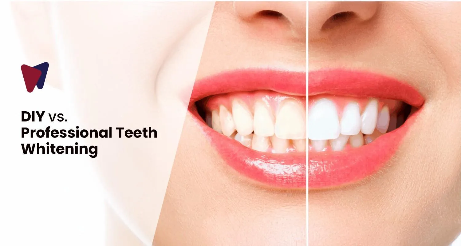 DIY Vs. Professional Teeth Whitening: What Is The Real Difference?