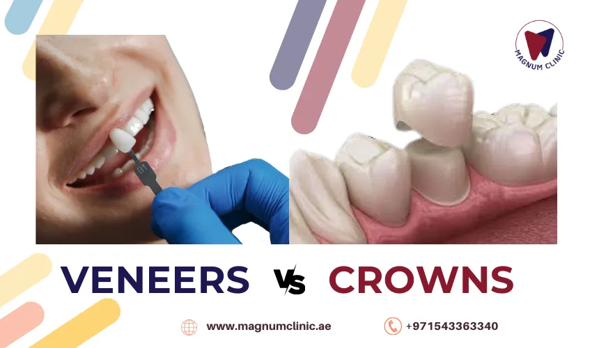 Veneers vs. Crowns: Which is Better to Save Your Pearly White Smile?