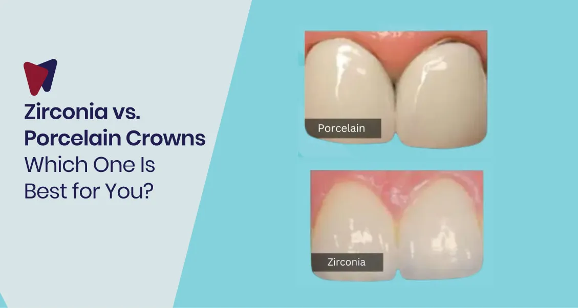 Zirconia Vs. Porcelain Crowns: Which Is The Best Option?