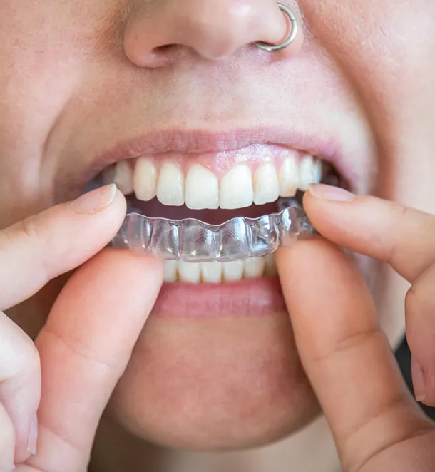 Teeth Aligner Cost In Dubai