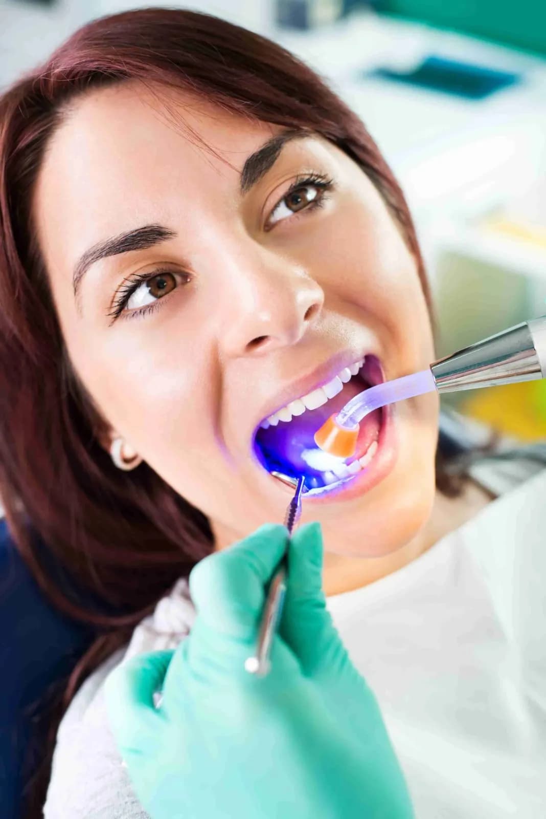 Risks and Limitations of Composite Veneers