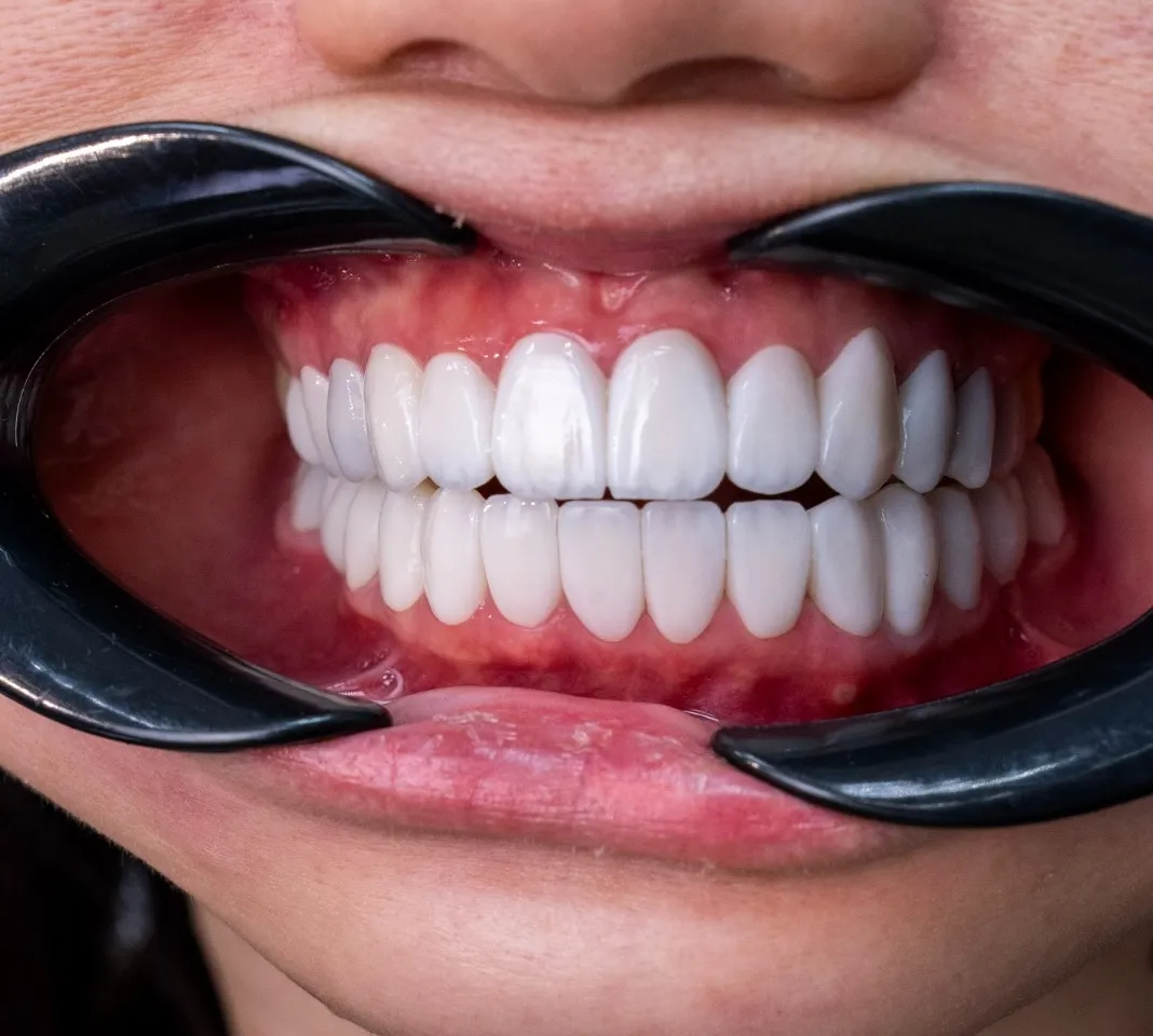 Smile transformation 2 - After