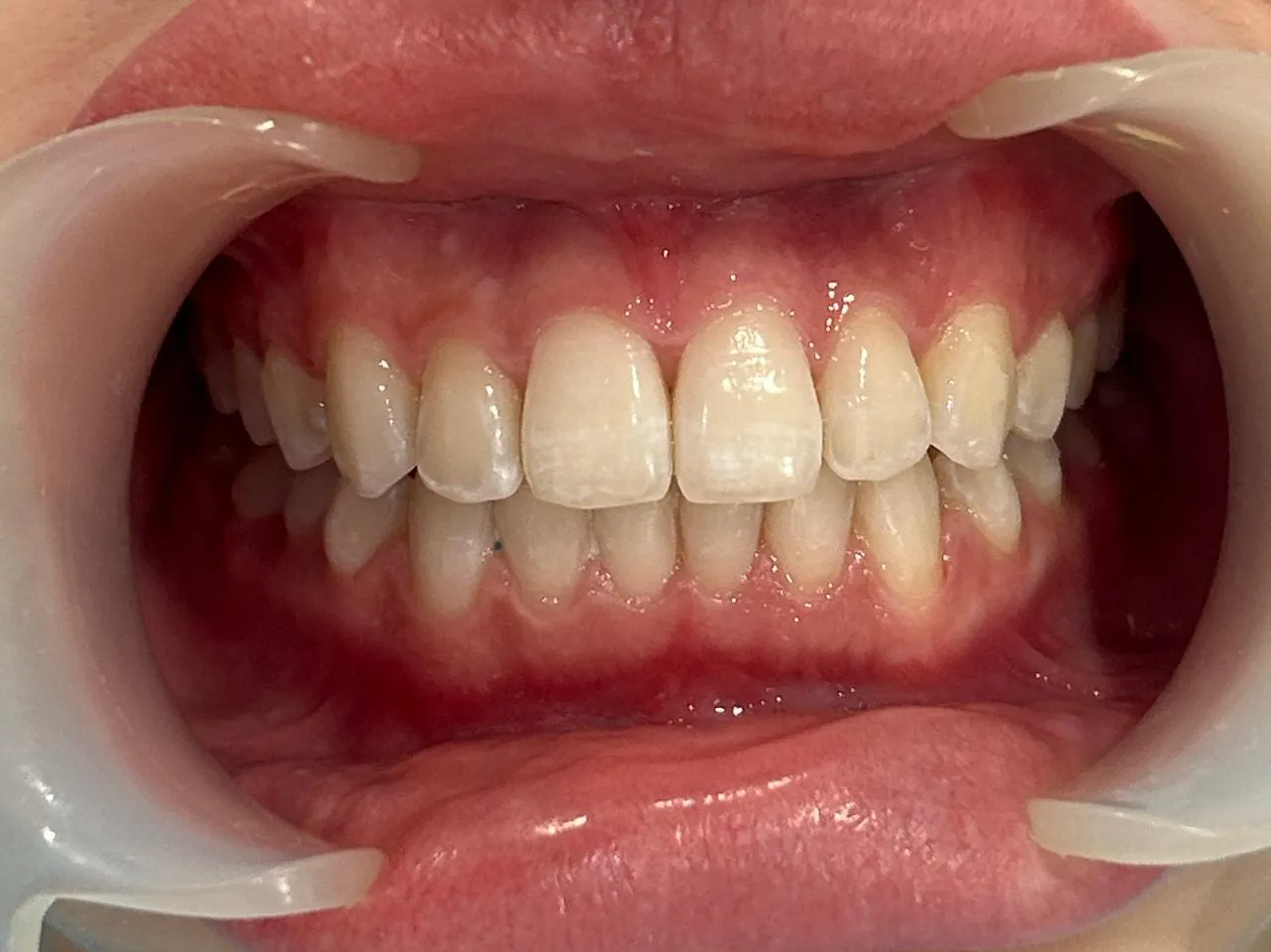 Smile transformation 3 - After