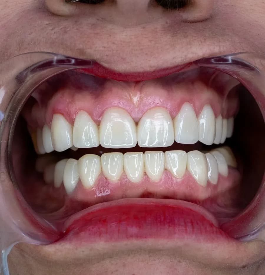 Smile transformation 6 - After