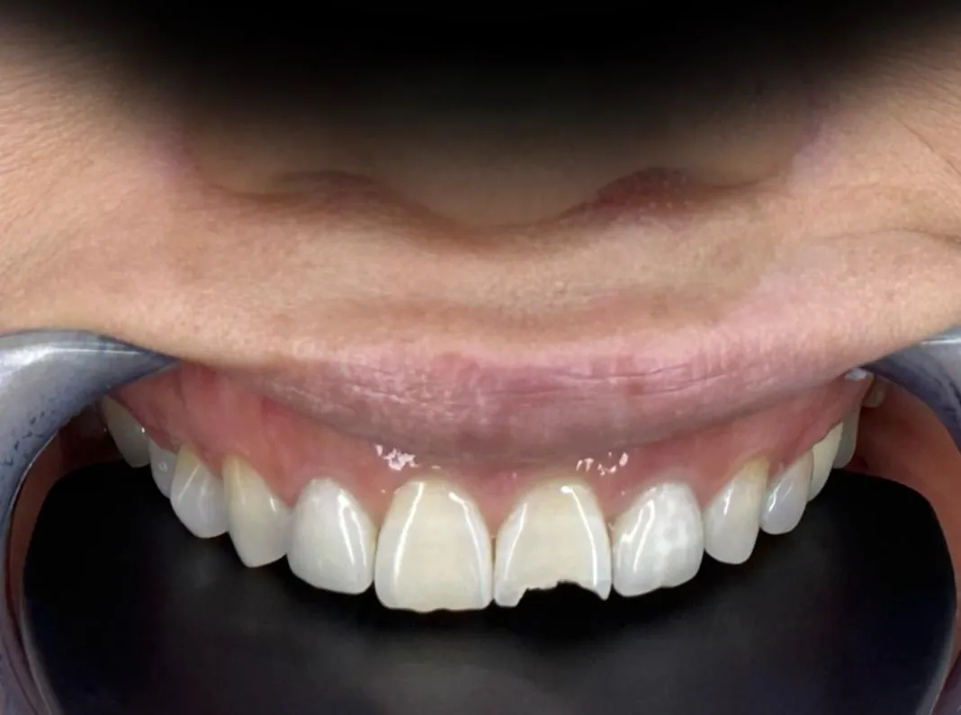 Smile transformation 5 - Before