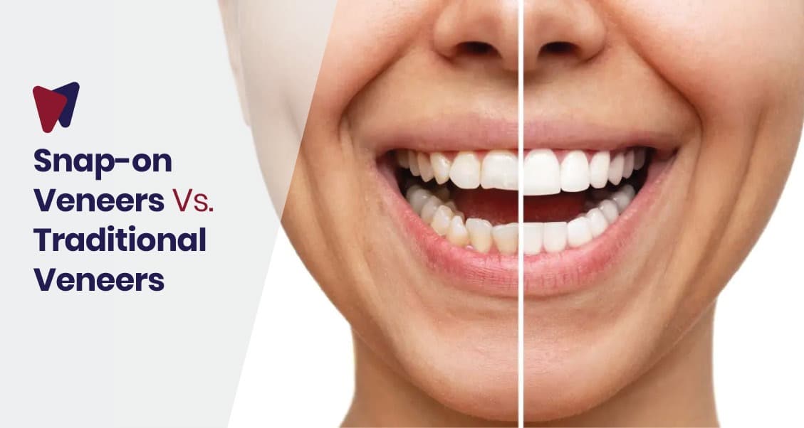 Snap-on Veneers Vs. Traditional Veneers: Which Are The Best?