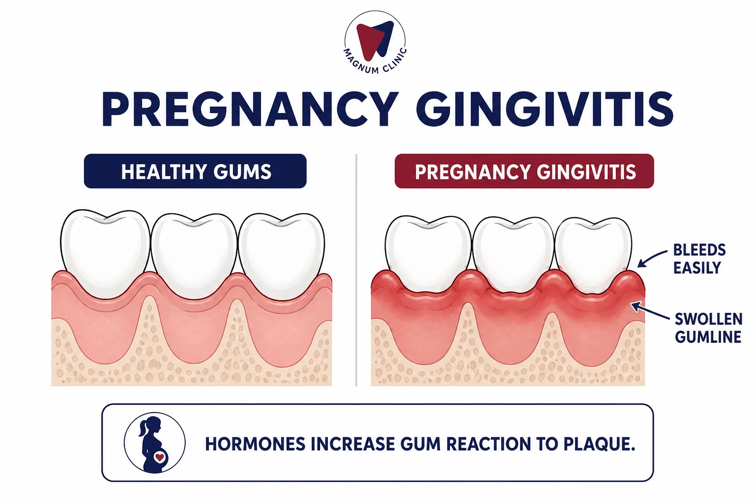 Pregnancy gingivitis compared with healthy gums at Magnum Clinic Dubai