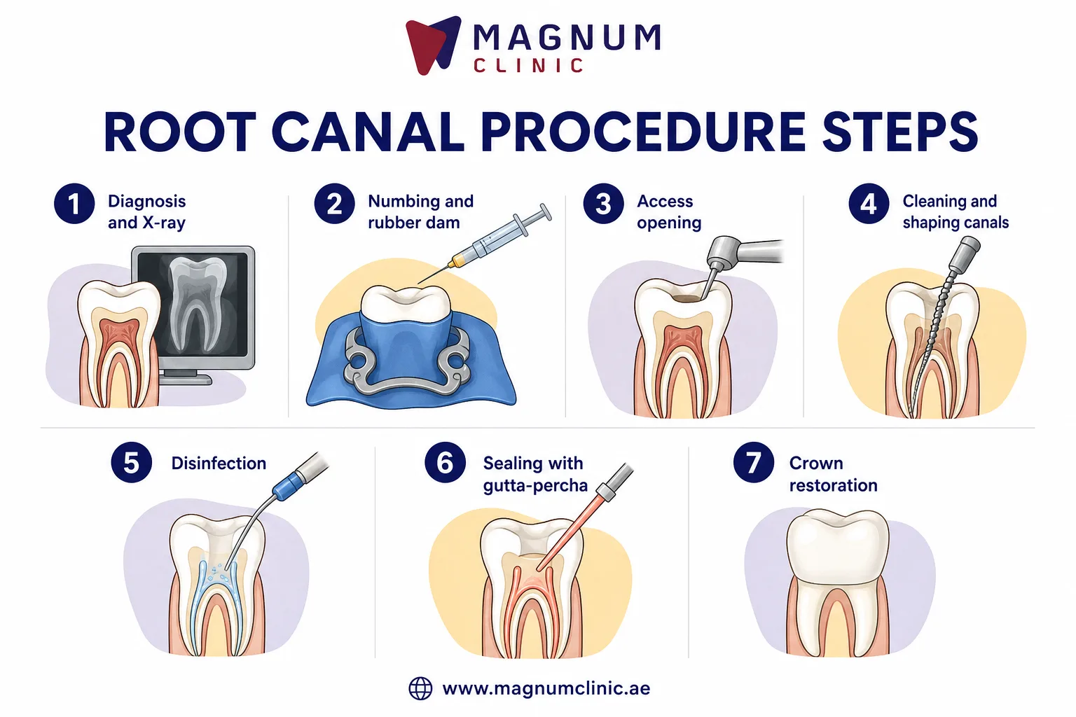 Root canal procedure steps from diagnosis and X-ray to cleaning, sealing and crown at Magnum Clinic Dubai