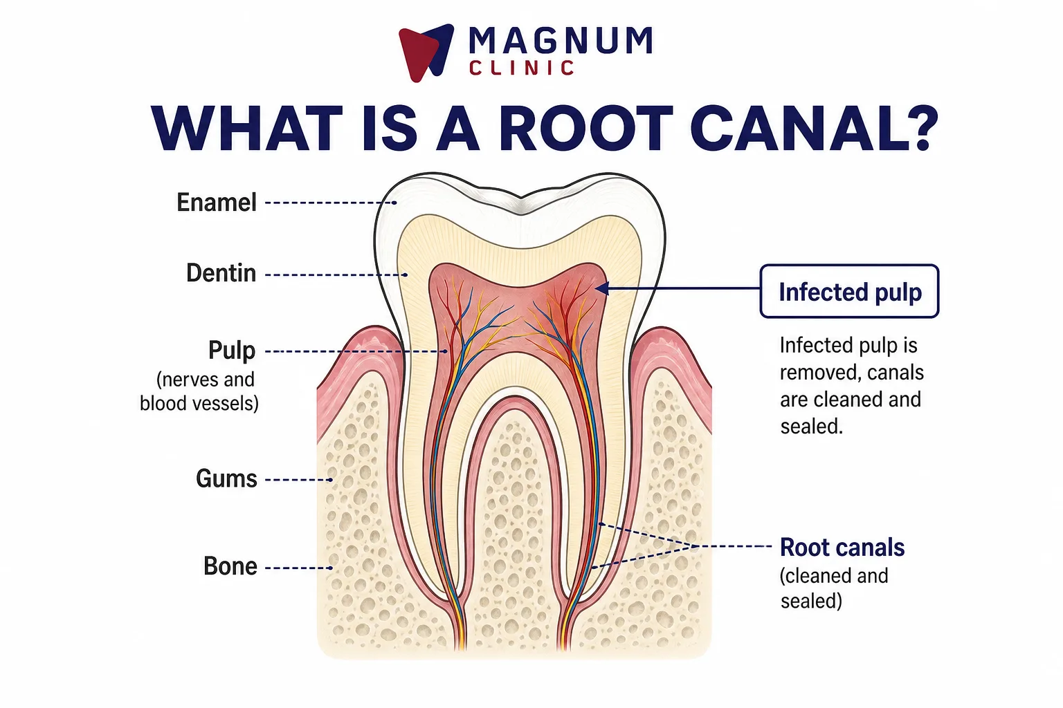 What is a root canal: tooth pulp, enamel, dentin and root canals explained at Magnum Clinic Dubai