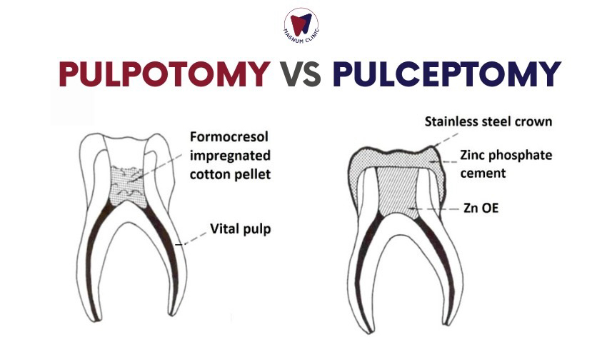 Pulpectomy vs pulpotomy