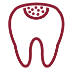 Pulpectomy Procedure