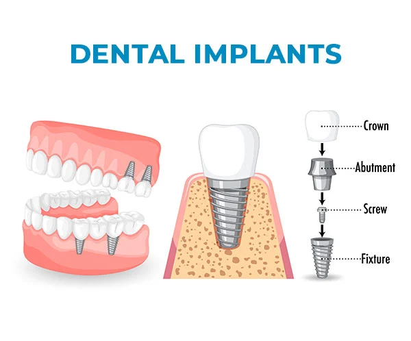 dental implants near me