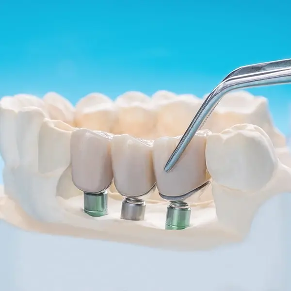 Dental_Bridge_Image