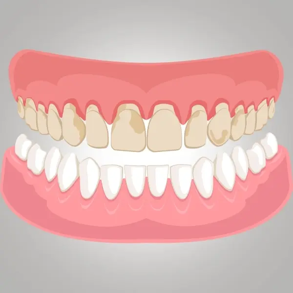 Dental_Cervical_Abrasions_Image