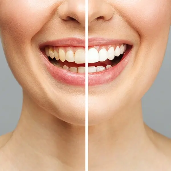 Teeth Whitening in Dubai