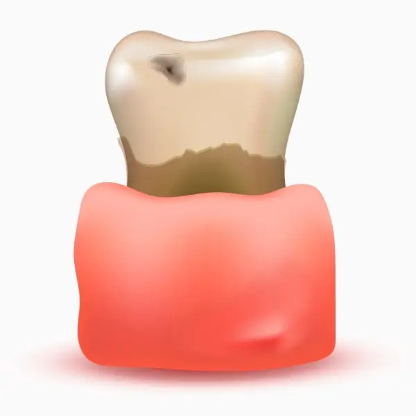 Tooth_Erosion_Image