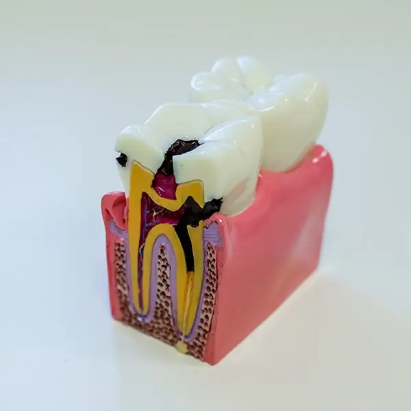 Tooth Decay Treatment Image