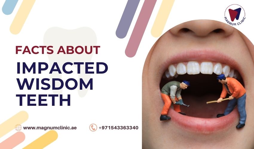 Facts About Impacted Wisdom Teeth