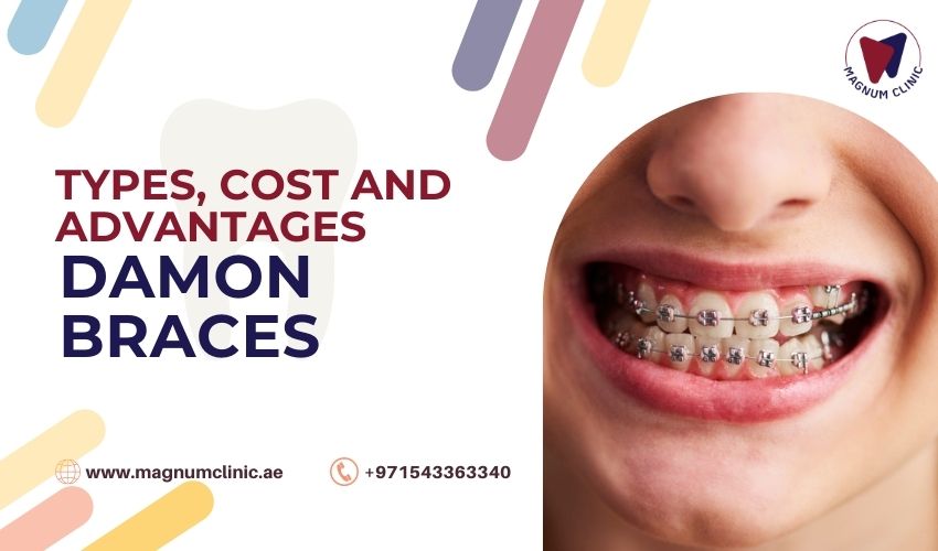 Damon Braces - Types-Cost-Benefits