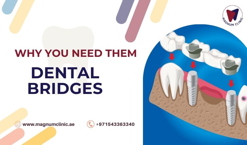 Dental Bridges