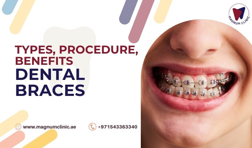 Types Of Dental Braces Treating Misaligned And Crooked Teeth With Braces 