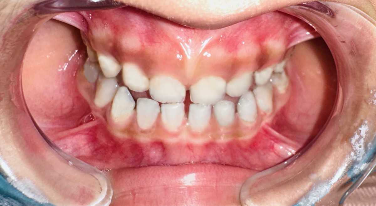 The teeth of the child would be shown as a description of the professional stain removal in Dubai