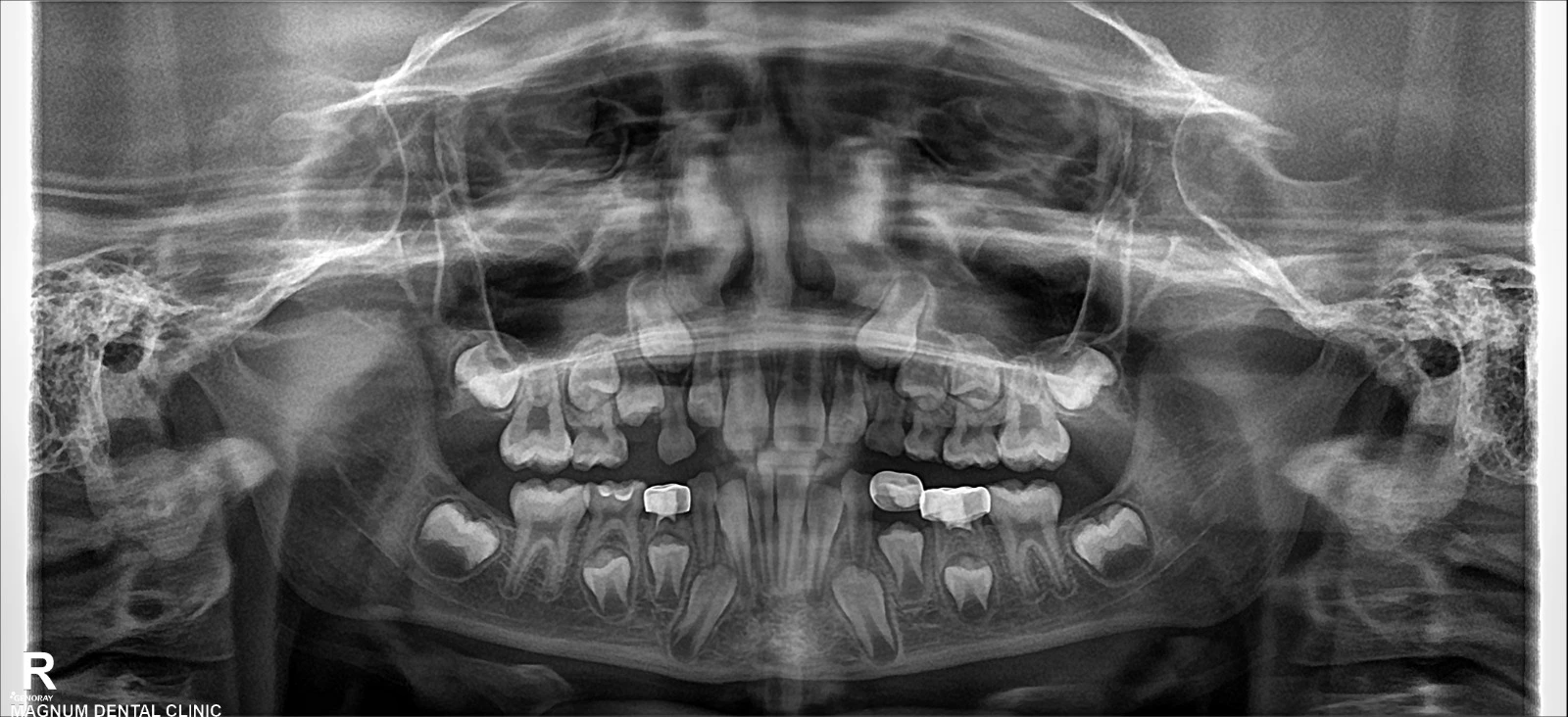 OPG shows a missing primary molar and a developing permanent premolar.