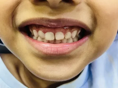 Primary front teeth restored with composite fillings after treatment.