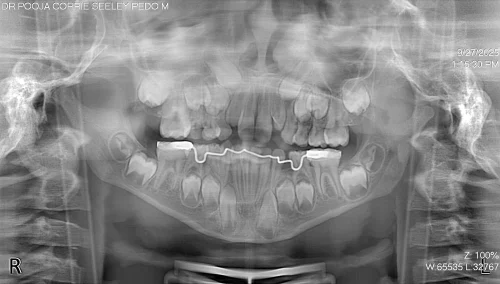 Fixed lingual holding arch with U-loops maintaining space after treatment.
