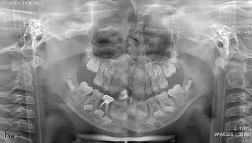 Stainless steel crown on his lower primary right molar