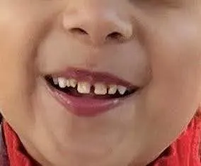 Decayed primary front teeth before composite filling treatment