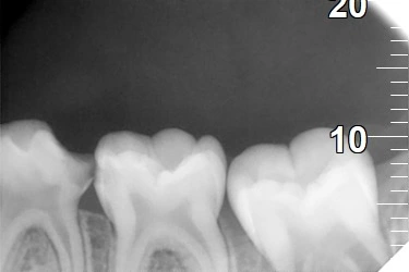 Swollen, severely carious primary lower right molar.