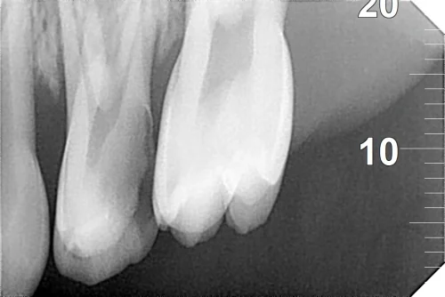 Primary maxillary molar with deep caries and infection before pulpectomy.