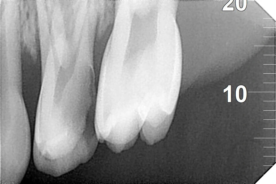 Primary maxillary molar with deep caries and infection before pulpectomy.