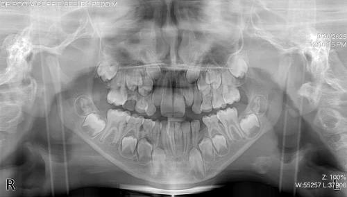 Image shows the lower arch missing a key primary molar with initial drifting present.