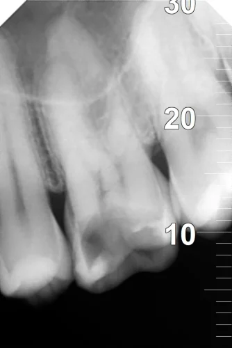 X Ray before Root Canal