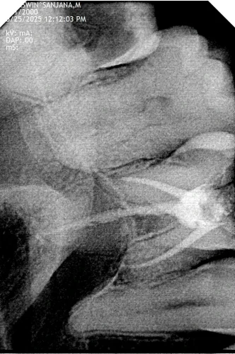 X Ray After Root Canal Treatment
