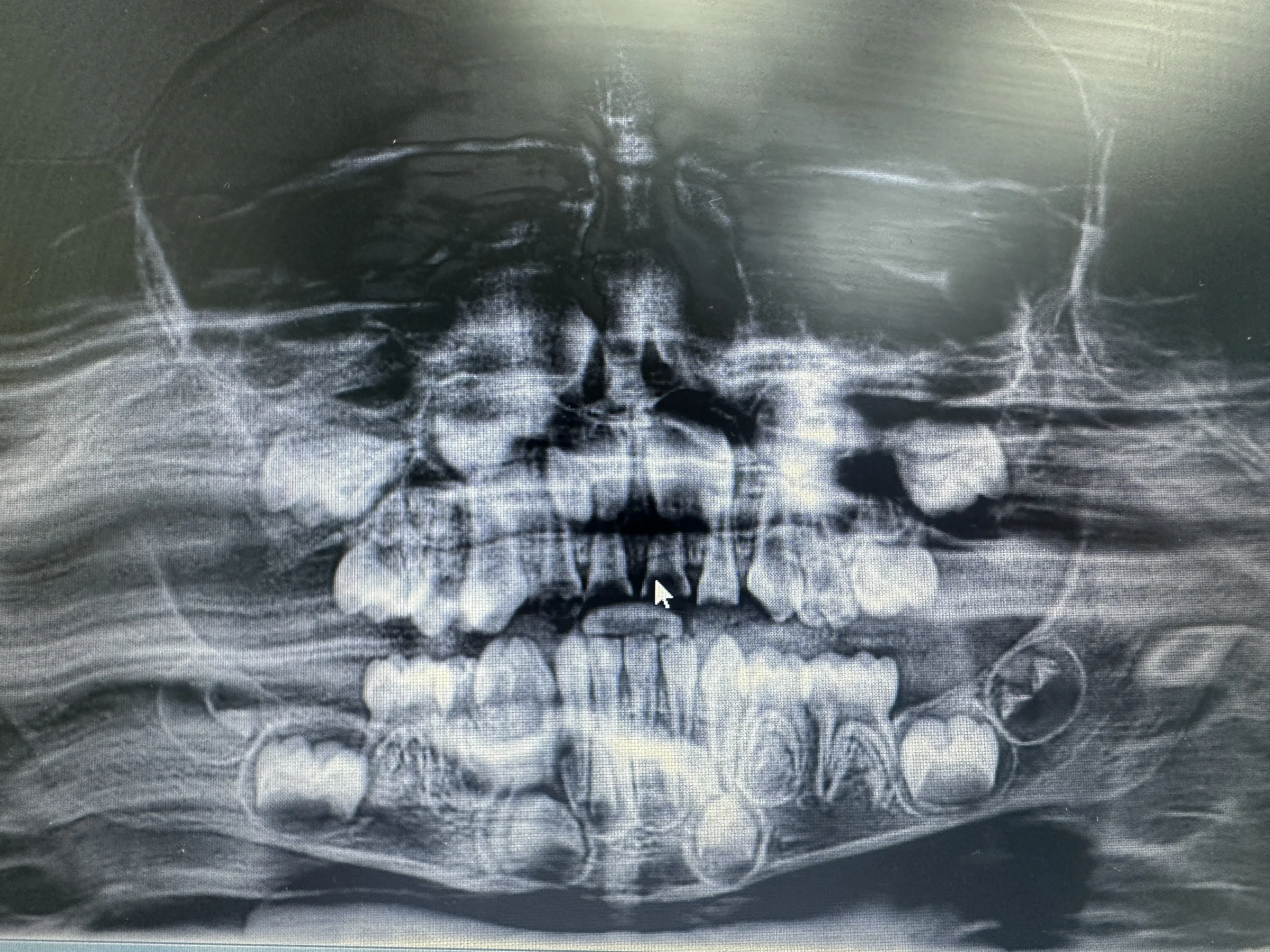 Decadent primary upper anterior teeth with severe caries and pulpal involvement before treating with pulpectomy.