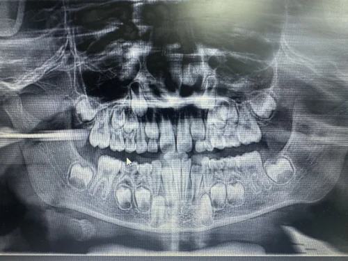 The decayed primary lower molar showed furcation radiolucency before the pulpectomy.