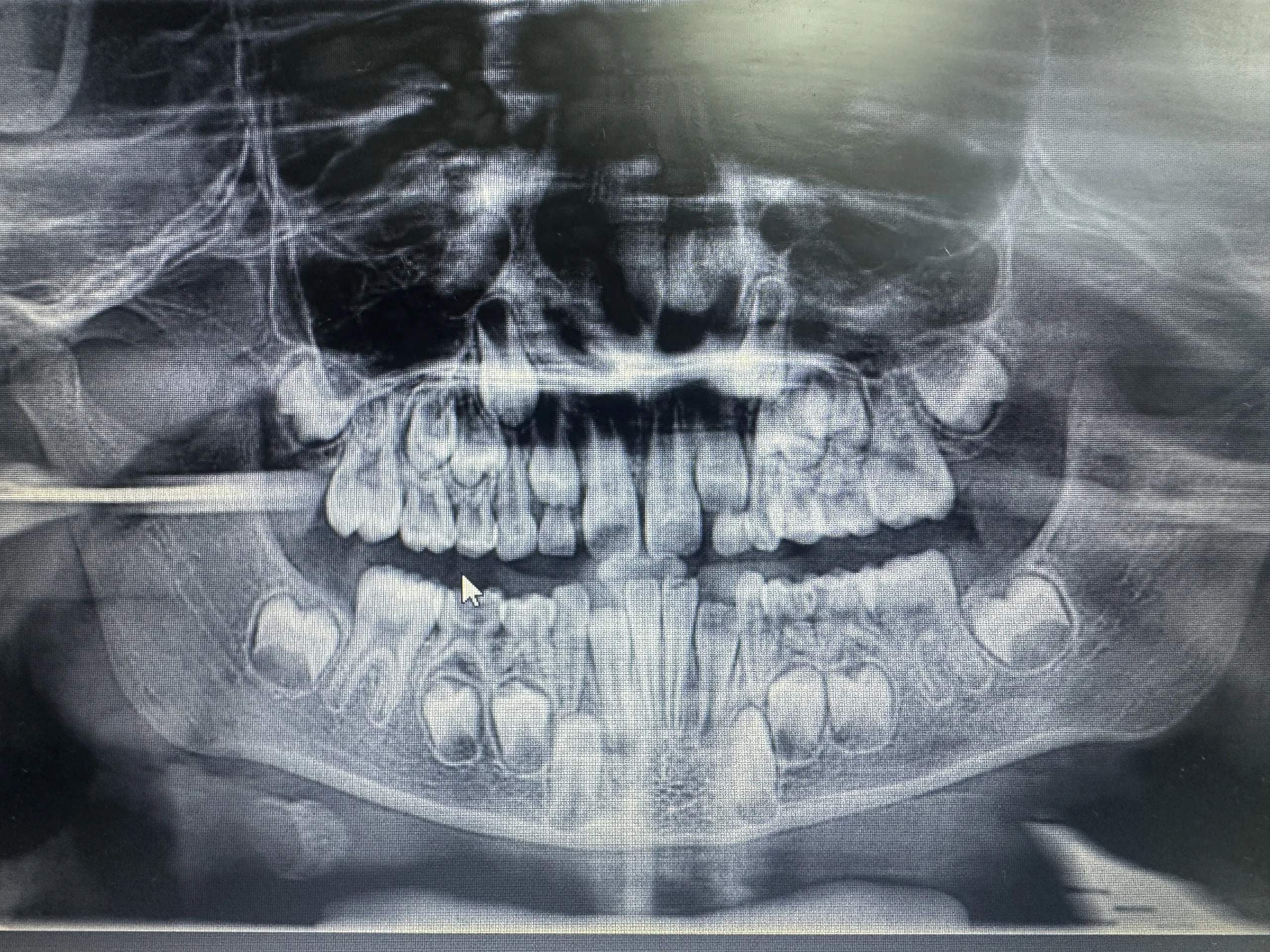 The decayed primary lower molar showed furcation radiolucency before the pulpectomy.