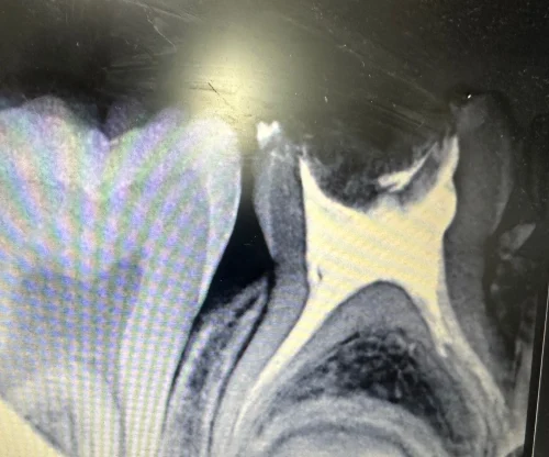 Biolex crown restoration on primary molars following pulpectomy.