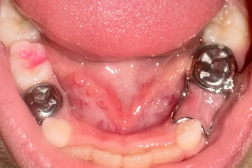 Pediatric dental x-ray with space maintainer—band and loop—lower jaw